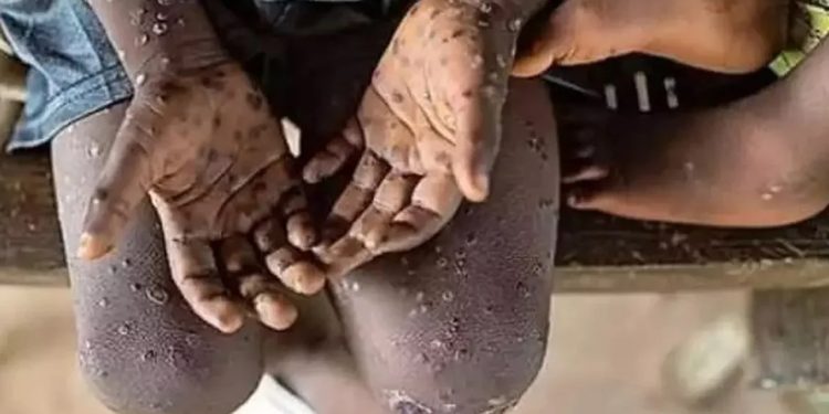 Afrika’da maymun çiçeği kontrolden çıktı